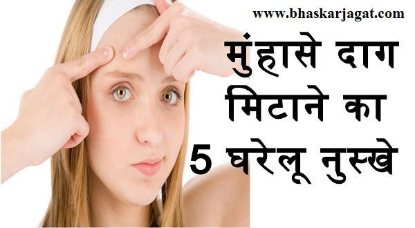 Eliminate acne by adopting these home remedies.